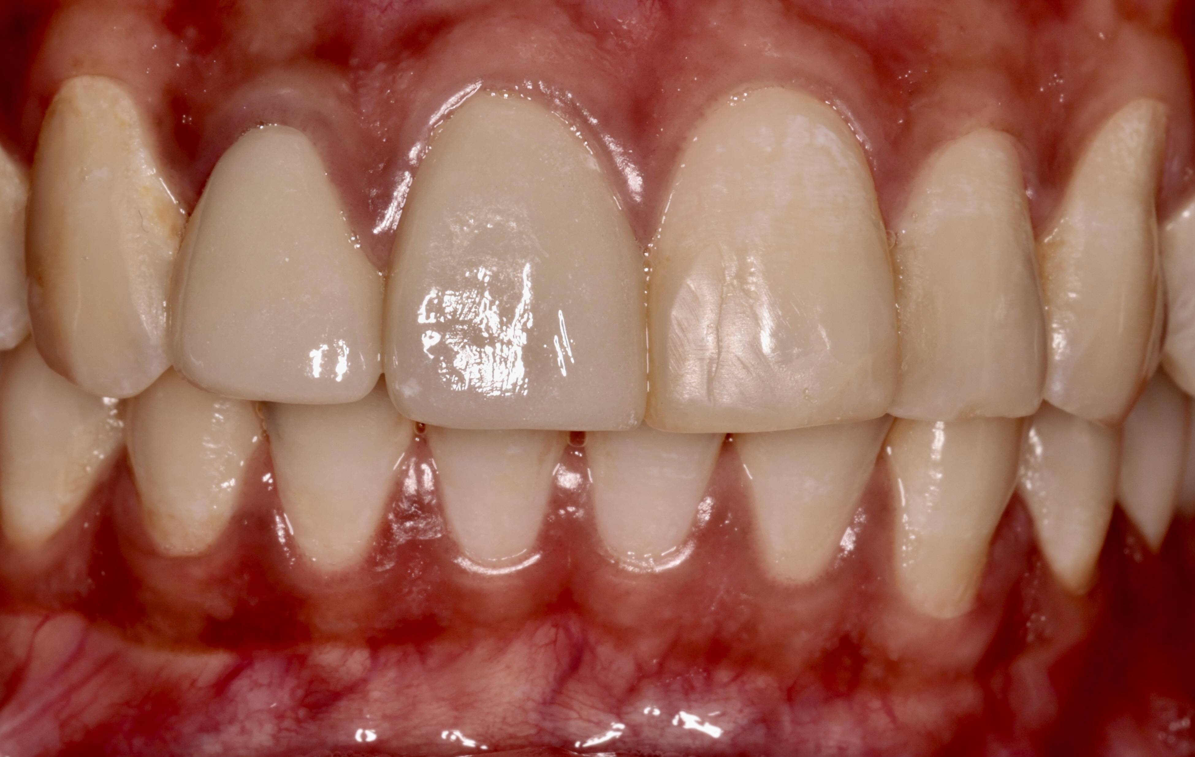 Ceramic veneers cemented